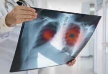 Doctor holding lung X-ray with highlighted areas
