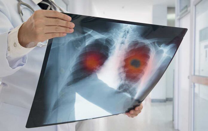 626631452 featured image Doctor holding lung X-ray with highlighted areas
