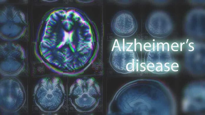 1054068035 featured image Brain scans labeled Alzheimers disease background